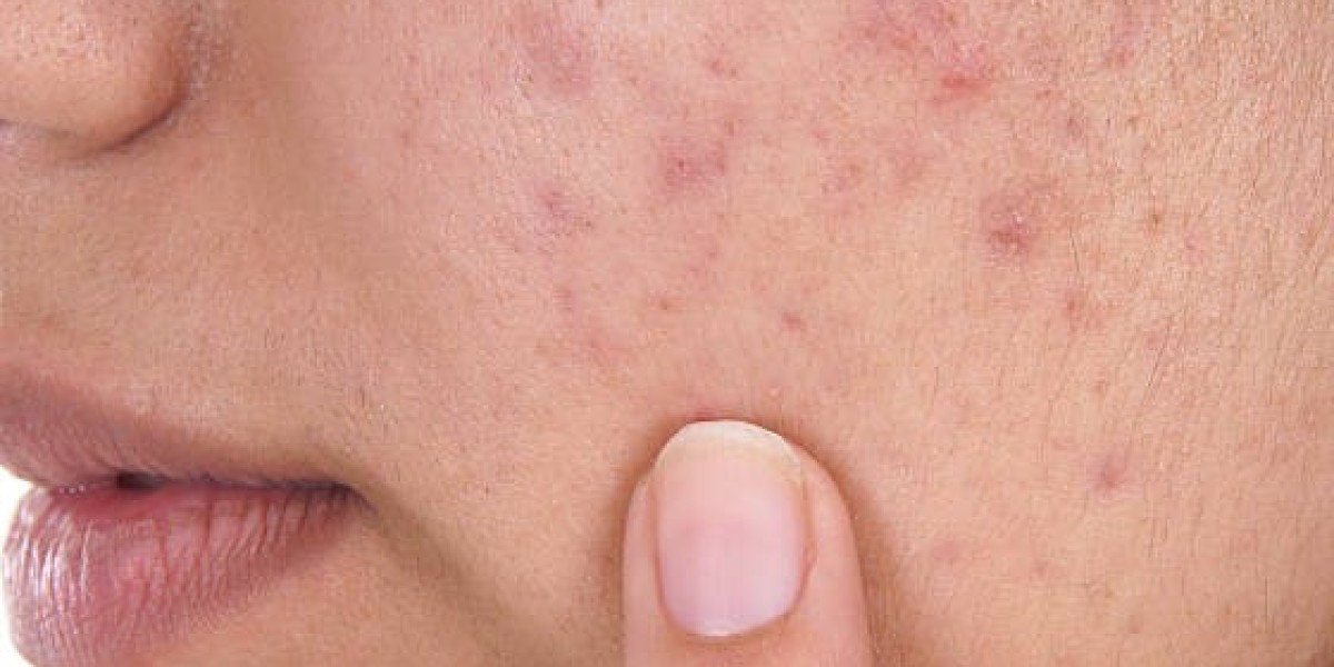Acne Scar Treatments from House of Aesthetics Can Transform Your Skin