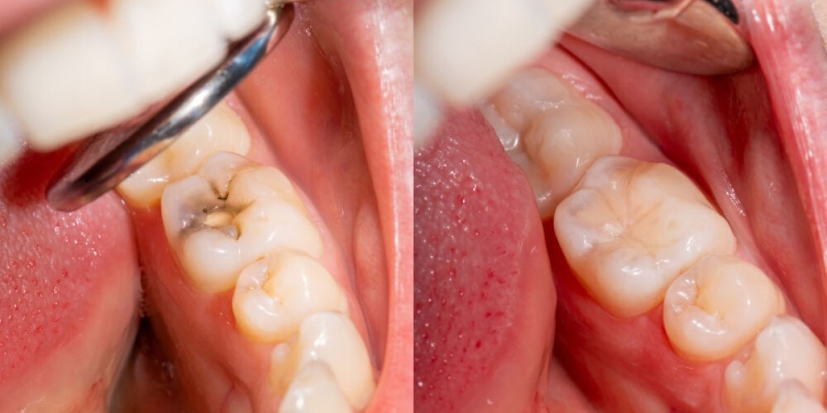 What You Need to Know About Dental Sealants: Myths and Facts