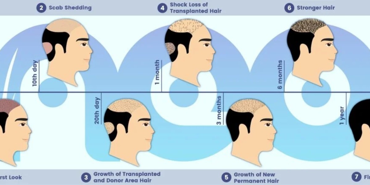 Hair Replacement in Turkey: A Comprehensive Guide to Restoring Your Confidence