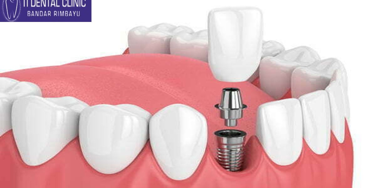 Teeth Veneers: What Influences the Cost at Tidental